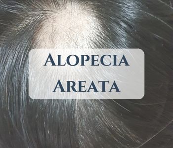Alopecia Areata