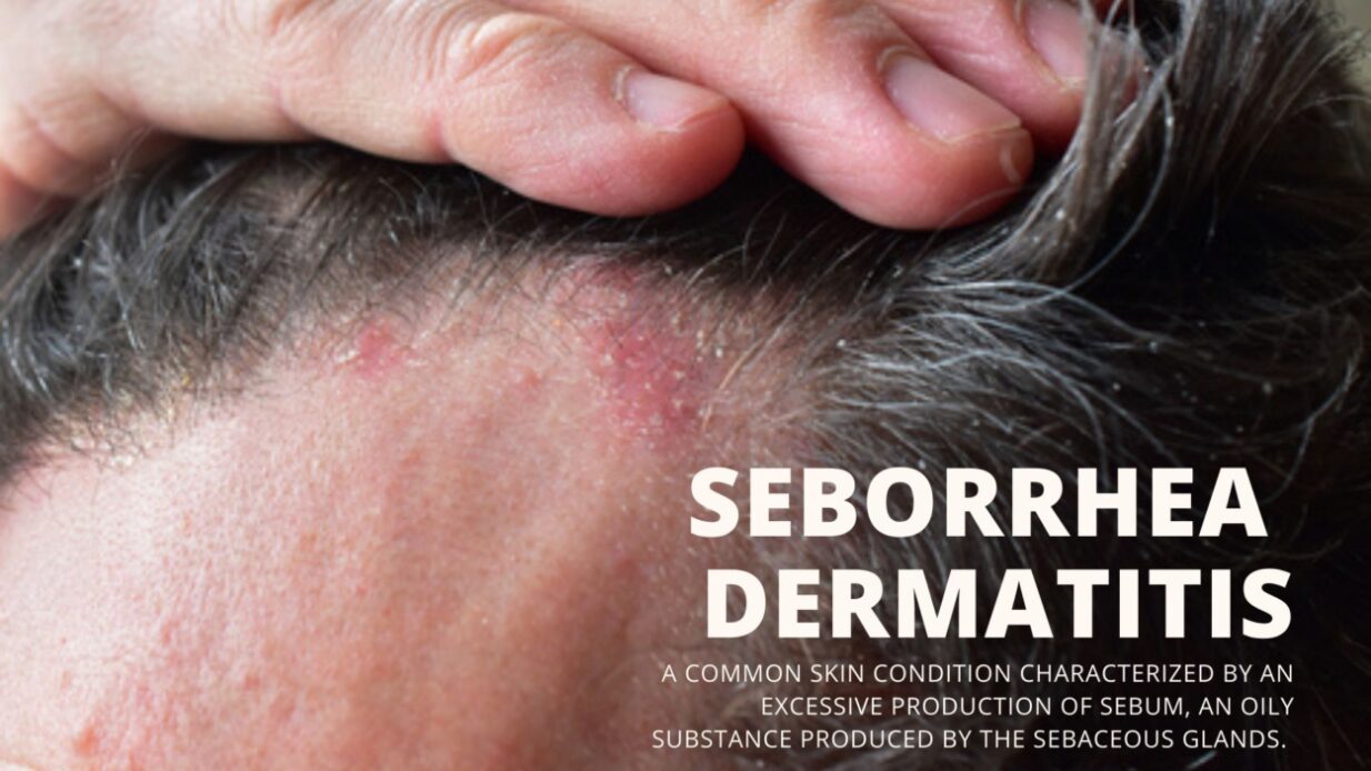 Seborrhea Dermatitis